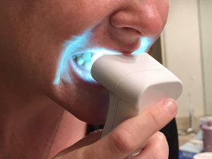 Whiter Teeth with Luster #teeth #beauty #luster #ad