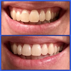 Whiter Teeth with Luster #teeth #beauty #luster #ad