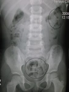 A close up X-ray of a person constipated