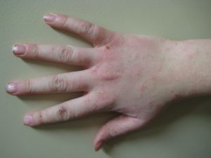 A hand with dermatitis