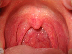 close up of back of throat