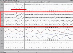 A close up of rapid eye movement graph