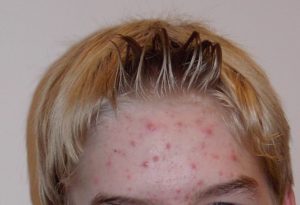A close up of a person with acne on forehead