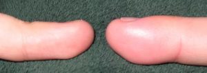 A swollen thumb