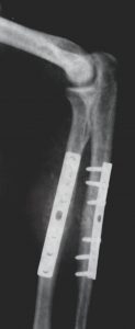 A close up of a bone implant